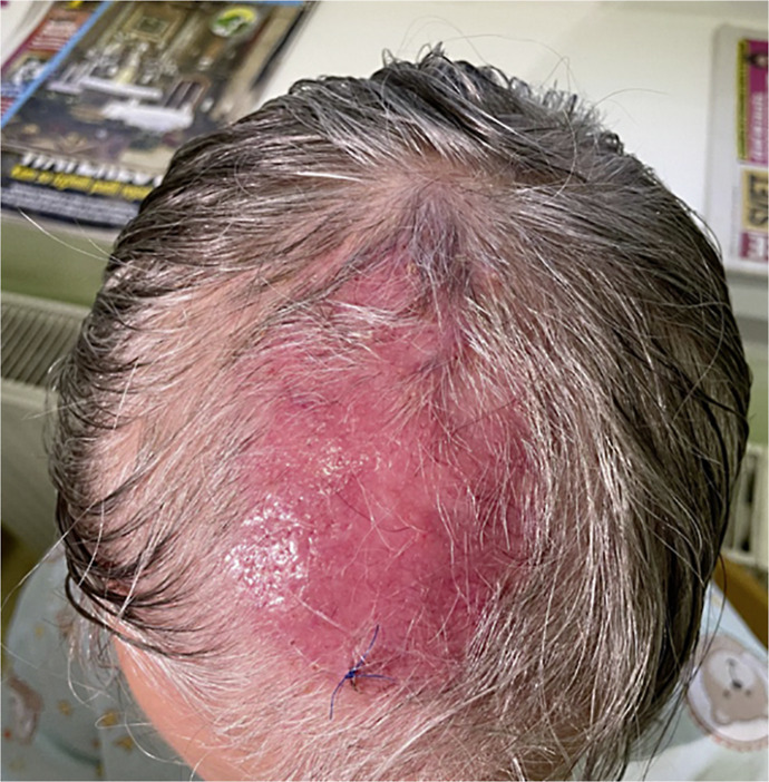 Kerion Celsi in Elderly Female, Caused by <i>Trichophyton rubrum</i>: Case Report.