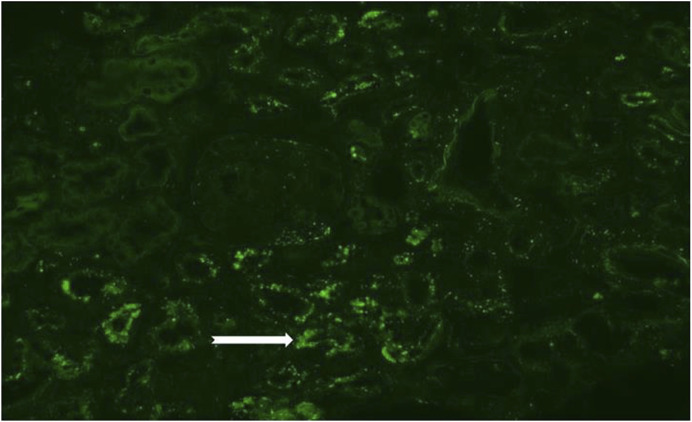 Case Report: Toxic tubulointerstitial nephropathy with lipofuscin deposition - the potential cause of occupational Bisphenol-A exposition.