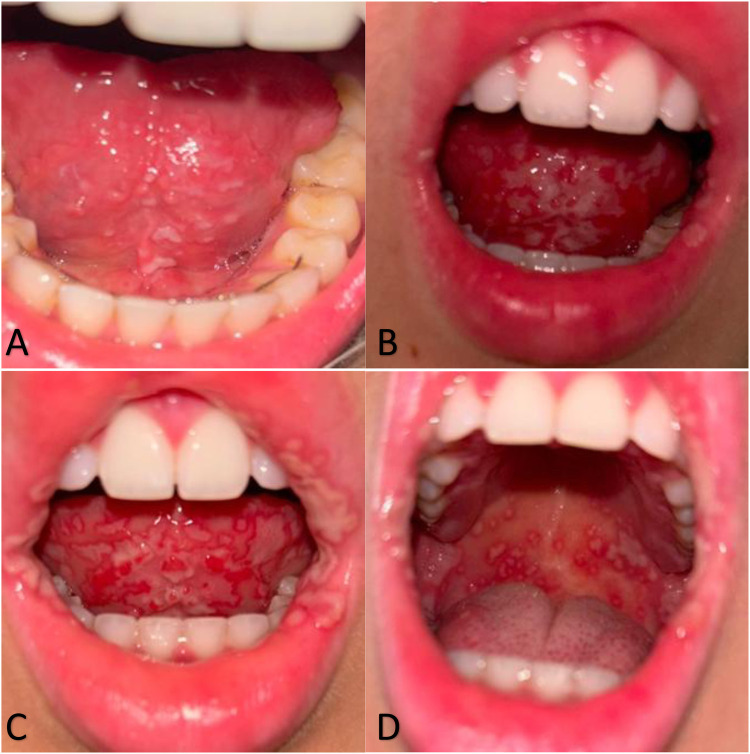 Acute-onset stomatitis in a young European woman visiting Brazil: a case report.