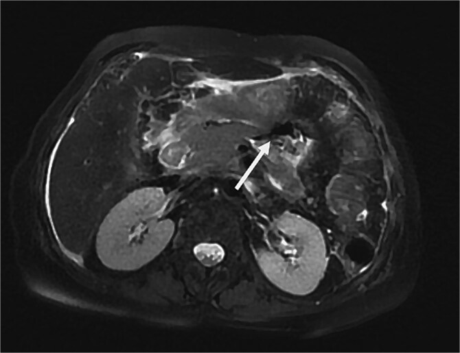 A case report of disconnected pancreatic duct syndrome: an underrecognized complication of acute necrotizing pancreatitis.