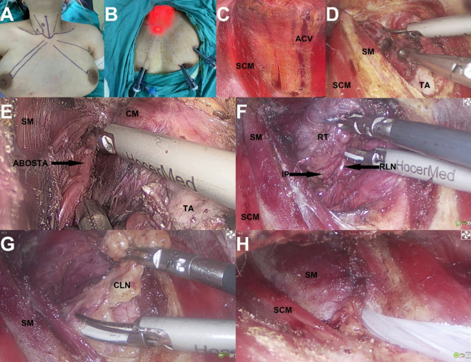 Comparison of the surgical outcomes of endoscopic thyroidectomy via a contralateral-axillo-bilateral-breast approach and open thyroidectomy.