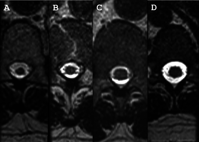 Magnetic resonance imaging in the diagnosis of HTLV-1-associated myelopathy.