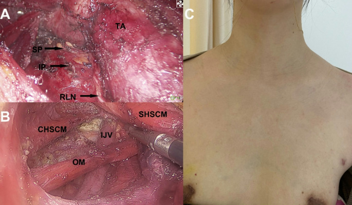 Comparison of the surgical outcomes of endoscopic thyroidectomy via a contralateral-axillo-bilateral-breast approach and open thyroidectomy.
