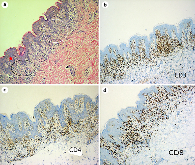 The Importance of Histopathology in the Diagnosis of Annular Lichenoid Dermatitis of Youth: A Case Report.