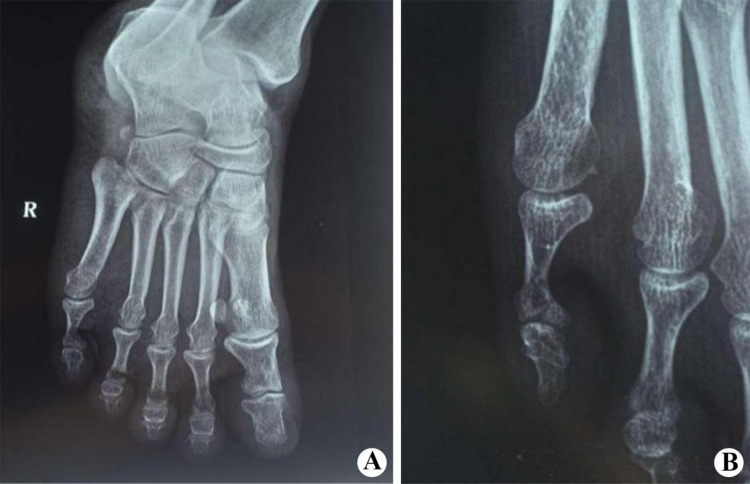 A Case of Palmoplantar Keratodermas Complicated by Pseudoainhum and Literature Review.