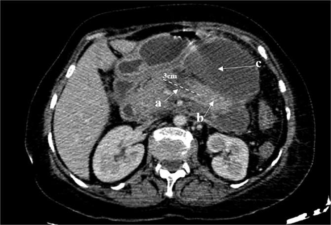 A case report of disconnected pancreatic duct syndrome: an underrecognized complication of acute necrotizing pancreatitis.