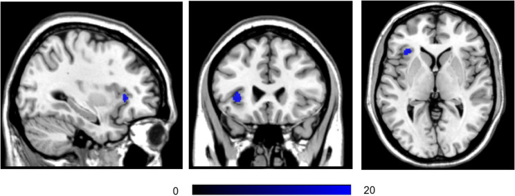 Morphological analysis and functional connectivity of the insular in patients with dysphagia after cerebral infarction based on resting-state fMRI.