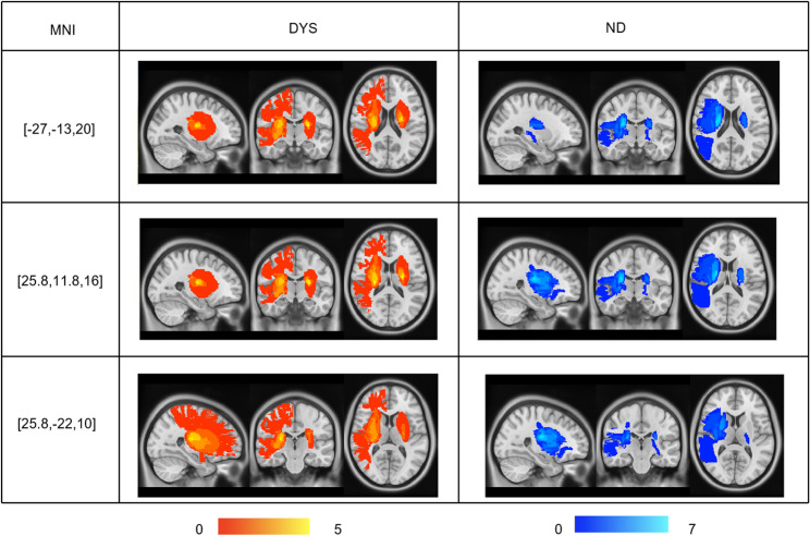 Morphological analysis and functional connectivity of the insular in patients with dysphagia after cerebral infarction based on resting-state fMRI.
