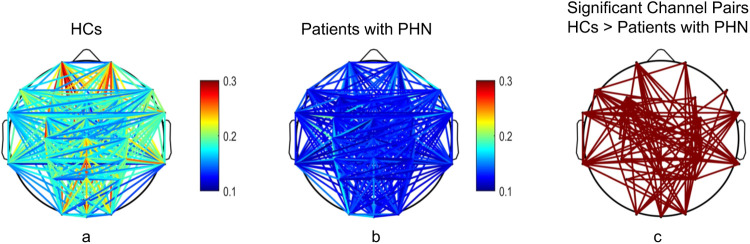 Altered neural oscillation patterns and functional connectivity in postherpetic neuralgia: evidence from resting-state EEG.