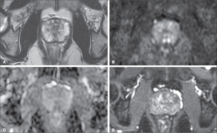 Predicting uninformative prostate magnetic resonance imaging sequences: a hypothesis-generating pilot study.