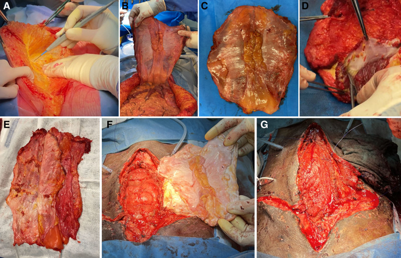 Long-term Outcome After Nonvascularized Rectus Fascia Transplantation in Solid Organ Transplantation: A Global Multicenter IIRTA Survey.