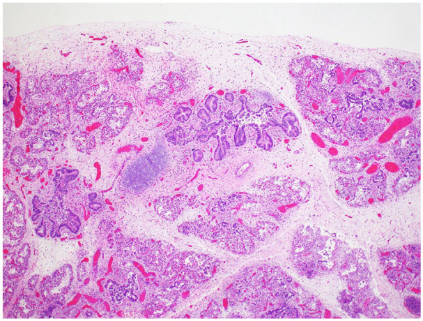 Primary Pulmonary Hypoplasia With Congenital Alveolar Dysplasia Associated With <i>TBX4</i> Gene Deletion: A Case With Autopsy and Molecular Findings.