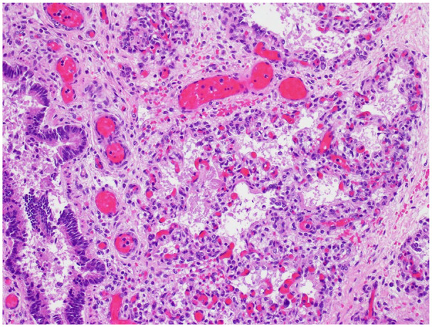 Primary Pulmonary Hypoplasia With Congenital Alveolar Dysplasia Associated With <i>TBX4</i> Gene Deletion: A Case With Autopsy and Molecular Findings.