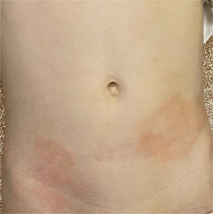 The Importance of Histopathology in the Diagnosis of Annular Lichenoid Dermatitis of Youth: A Case Report.