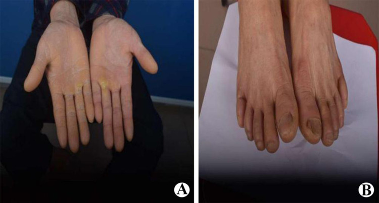 A Case of Palmoplantar Keratodermas Complicated by Pseudoainhum and Literature Review.