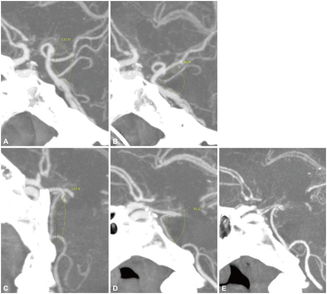Basilar Artery Angulation: A Novel Imaging Marker of Transtentorial Herniation.