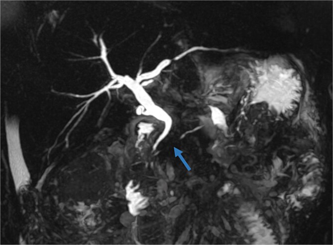 A case report of disconnected pancreatic duct syndrome: an underrecognized complication of acute necrotizing pancreatitis.