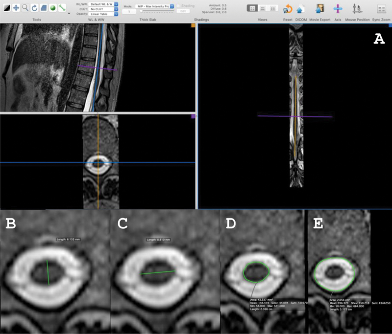 Magnetic resonance imaging in the diagnosis of HTLV-1-associated myelopathy.