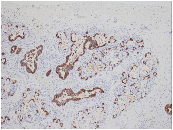 Primary Pulmonary Hypoplasia With Congenital Alveolar Dysplasia Associated With <i>TBX4</i> Gene Deletion: A Case With Autopsy and Molecular Findings.