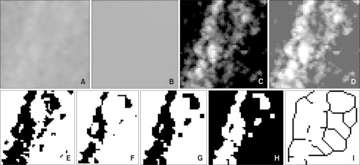 Fractal analysis of mandibular bone structure in individuals with unilateral crossbite.
