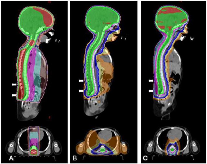 Relative risk of cardiac mortality and dosimetric comparison among three-dimensional radiotherapy, volume-modulated arc therapy and proton beam in vertebral-body reduced-dose craniospinal irradiation.