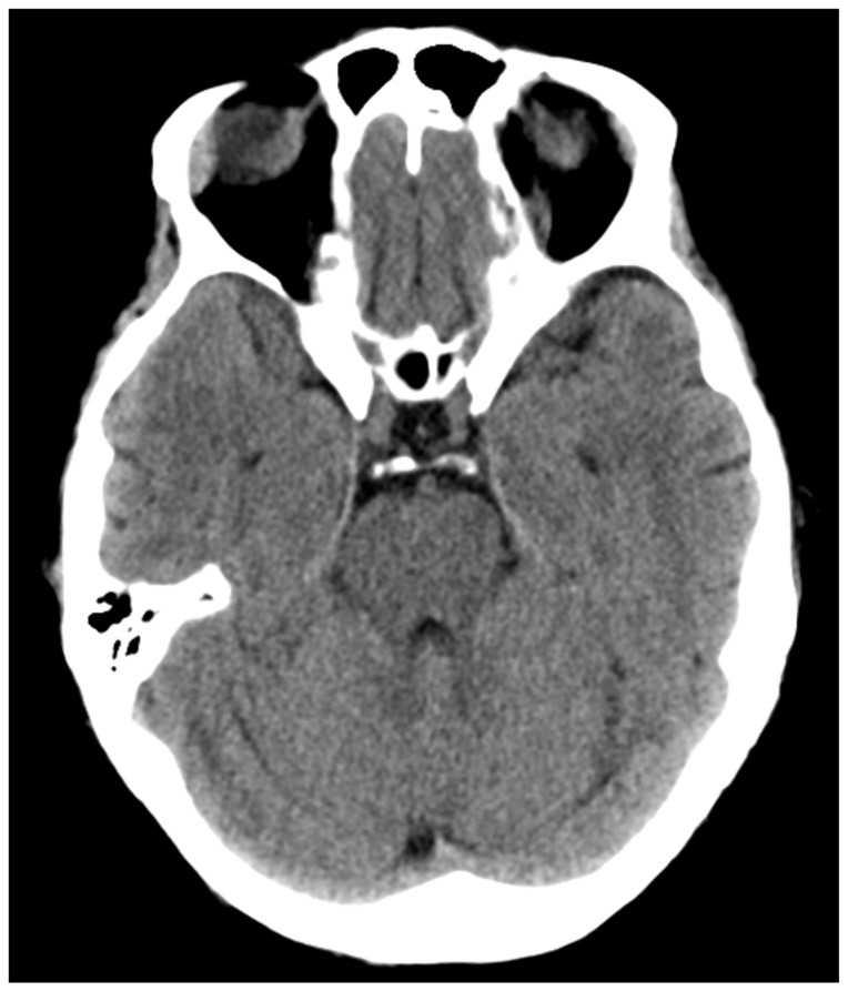 Posterior Reversible Encephalopathy Syndrome and Eclampsia.