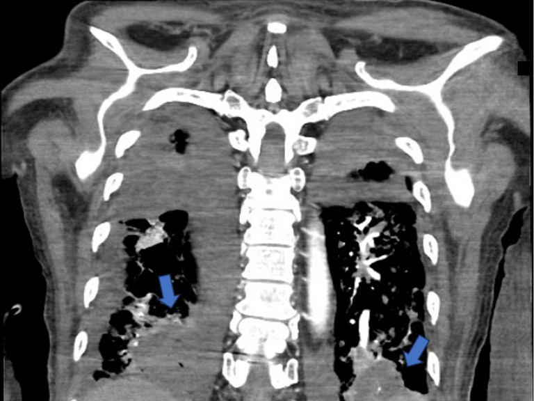 Multifocal bowel perforation from angioinvasive aspergillosis after bilateral lung transplantation: a case report and review of the literature.