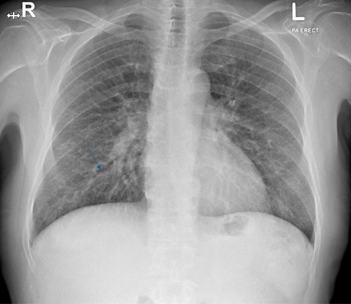 COVID-19 Induced Cholangiopathy: A Case Report.