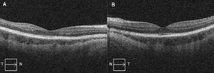Central Retinal Vein Occlusion Associated With Progestin-Only Contraceptive Implant Use.