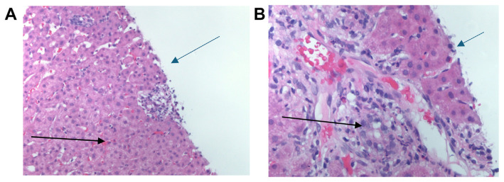 Diagnostic Challenges in Concurrent Primary Biliary Cholangitis and Secondary Syphilis: A Case Report.