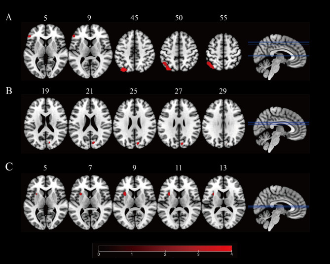 Abnormal static and dynamic regional homogeneity in adolescent major depressive disorder with somatic symptoms: a resting-state fMRI study.