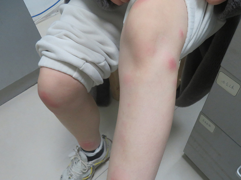 Bilateral granulomatous mastitis associated with ductoscopy.