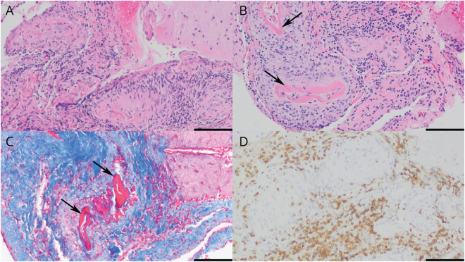 Biopsy-Confirmed Small Vessel Primary CNS Vasculitis: Clinical Features and Impact of Early Intensive Treatment on Remission.