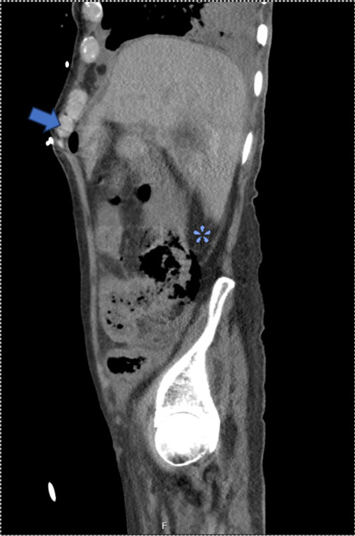 Multifocal bowel perforation from angioinvasive aspergillosis after bilateral lung transplantation: a case report and review of the literature.