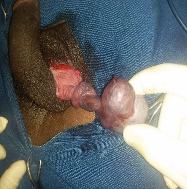 Atypical Testicular Torsion Due to an Epididymal Cyst in a Young Adult: Case Report.