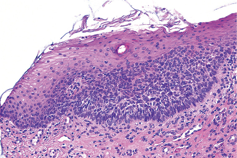 Case report of long-term disease control of recurrent intraoral basal cell carcinoma with vismodegib at two-year follow-up.
