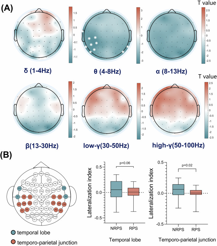 Enhanced theta oscillations in the left temporoparietal region associated with refractory positive symptoms in schizophrenia.