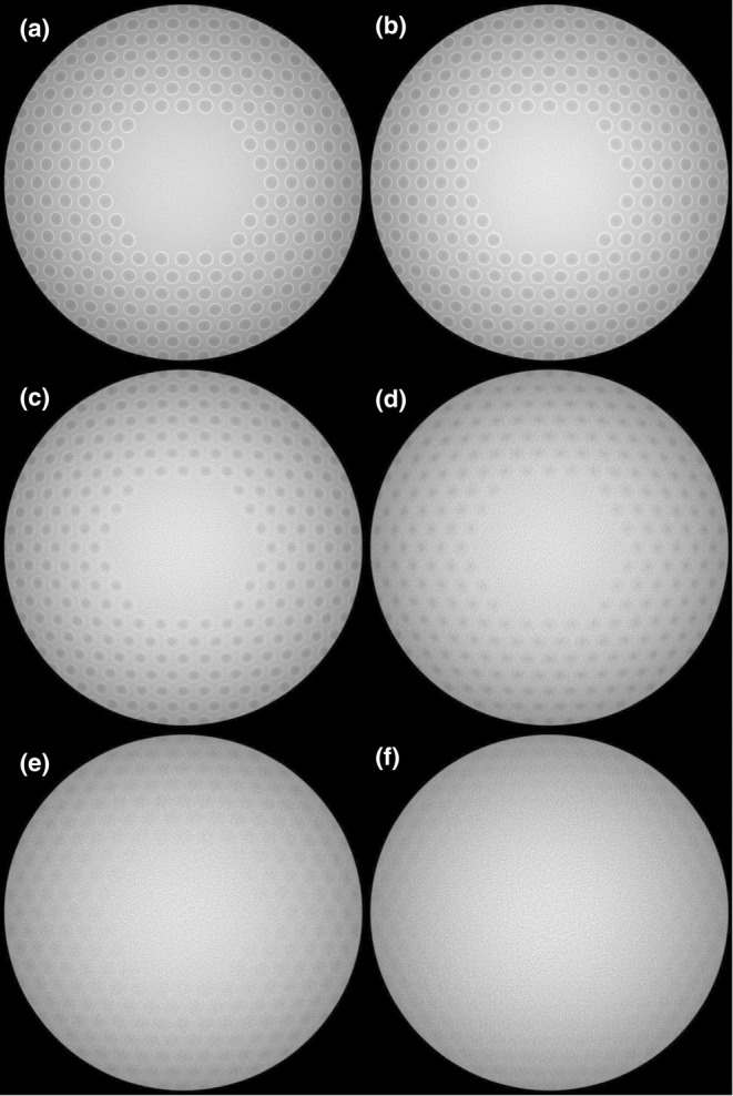 Retinal shadows of multisegment lenses in fundus imaging.