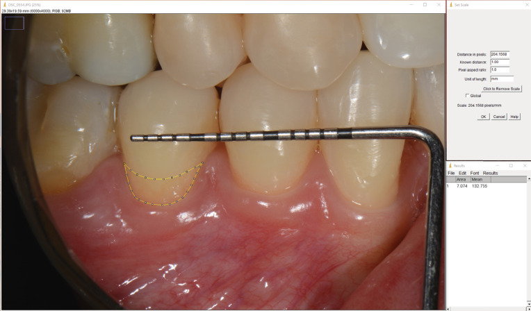 Clinical evaluation of the effect of 980 nm diode laser and fluoride varnish on dentin hypersensitivity.
