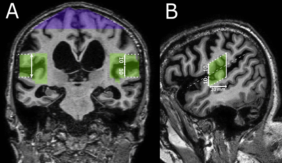 qDESH: a method to quantify disproportionately enlarged subarachnoid space hydrocephalus.