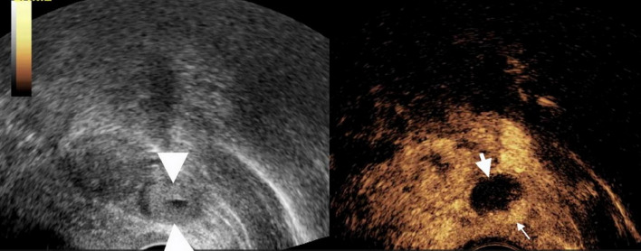 Contrast enhanced ultrasound - a useful method for diagnosing tubal ectopic pregnancy with low level β-HCG.