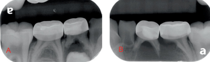The Kang Appliance: A Novel Tooth-Borne Approach to Decompression of Dentigerous Cysts in Pediatric Patients.