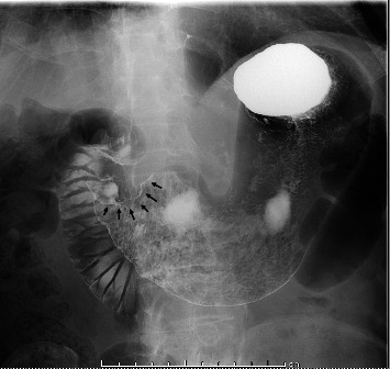 A Case of Ventricular Arrhythmia in a Patient With HER2-Positive Gastric Cancer Receiving Trastuzumab.