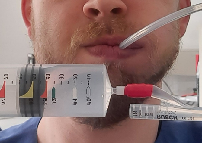 New measurement method for long-term oral complications after harvesting buccal mucosa grafts for urethroplasty.