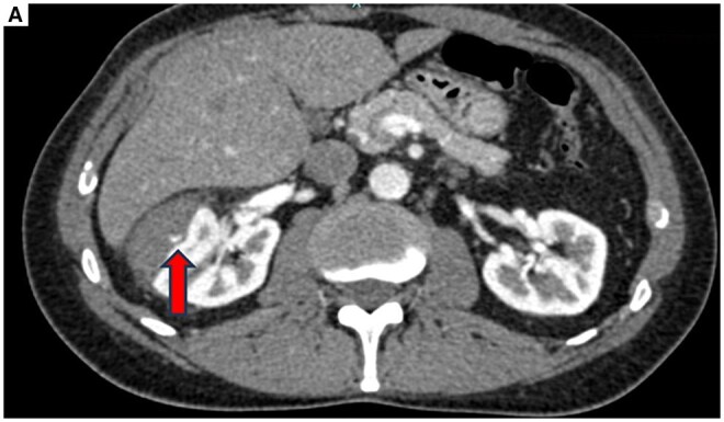 An unusual renal colic during trans-arterial embolization after trauma and its multidisciplinary management.