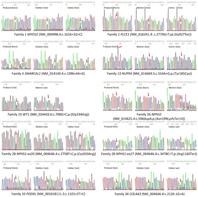 Whole genome sequencing identifies monogenic disease in 56.1% of families with early-onset steroid-resistant nephrotic syndrome.