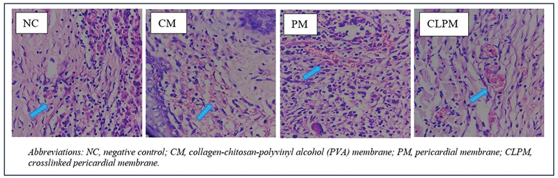 Biodegradation, Angiogenesis, and Inflammatory Response of a Collagen-Chitosan-Polyvinyl Alcohol (PVA) Membrane: In Vivo Model of Guided Tissue Regeneration.