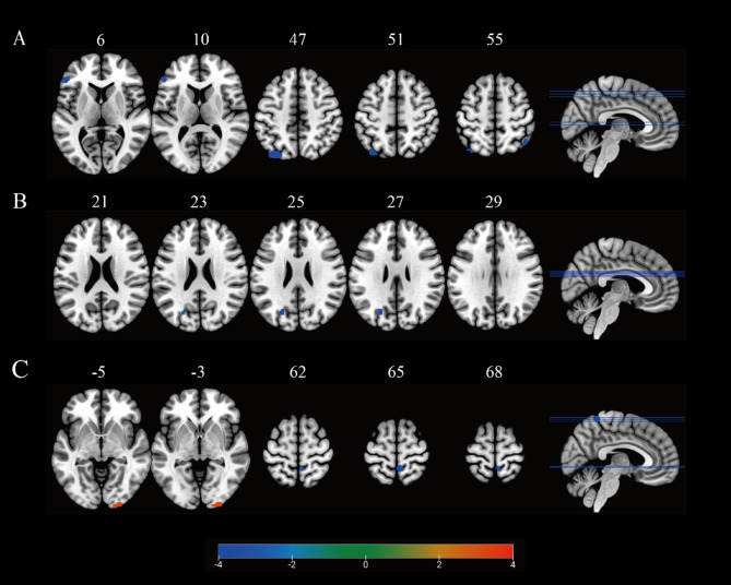 Abnormal static and dynamic regional homogeneity in adolescent major depressive disorder with somatic symptoms: a resting-state fMRI study.