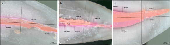 Evaluation of the Cleanliness and Sealer Penetration of the Root Canal System Following Final Irrigation Using Chelating Agents.