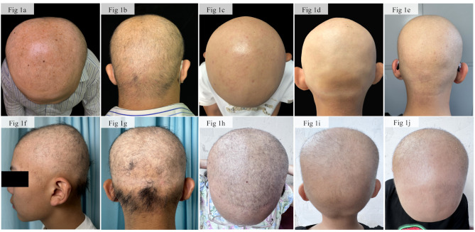 Hypotrichosis 14: novel variants of the LSS gene in five Chinese families and insights from literature review.